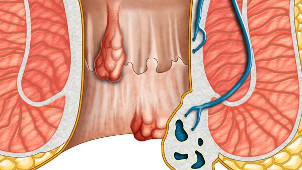间质性肺炎患者的日常锻炼方法