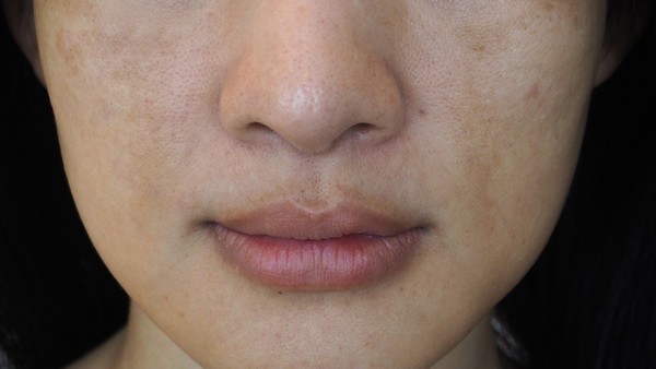 社区获得性细菌性肺炎的抗生素选择