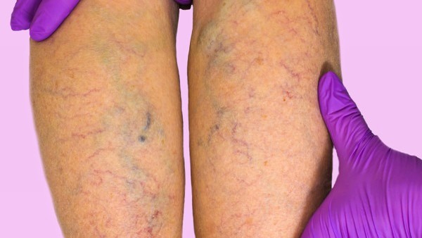 变异性哮喘的急性发作怎么办