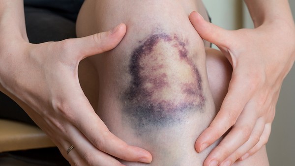 红痱是否和体质有关系