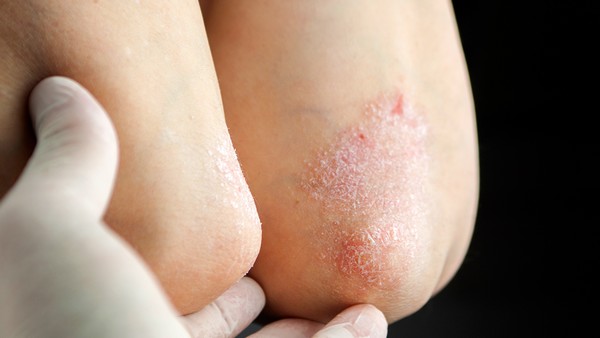 骨髓瘤的骨痛症状