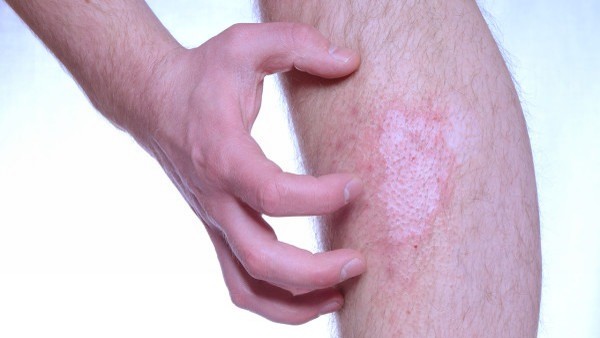 偏头痛患者的日常护理