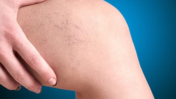 多囊卵巢综合症的中医治疗