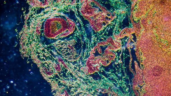 胃癌是否有遗传倾向